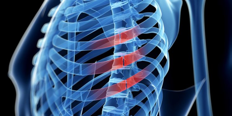 Image de synthèse du squelette d'une cage thoracique avec une côte fêlée